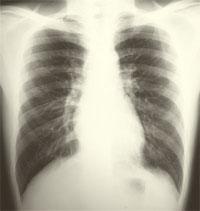 X-ray: Asbestos
